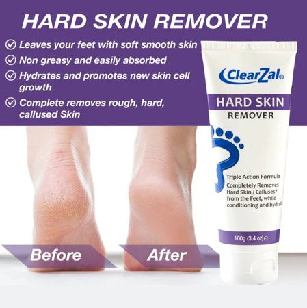 CLEARZAL Hard Skin Remover - 3.4 oz