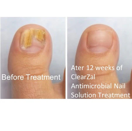 CLEARZAL Nail & Foot Kit Antimicrobial Nail Solution and Foot Sanitiser